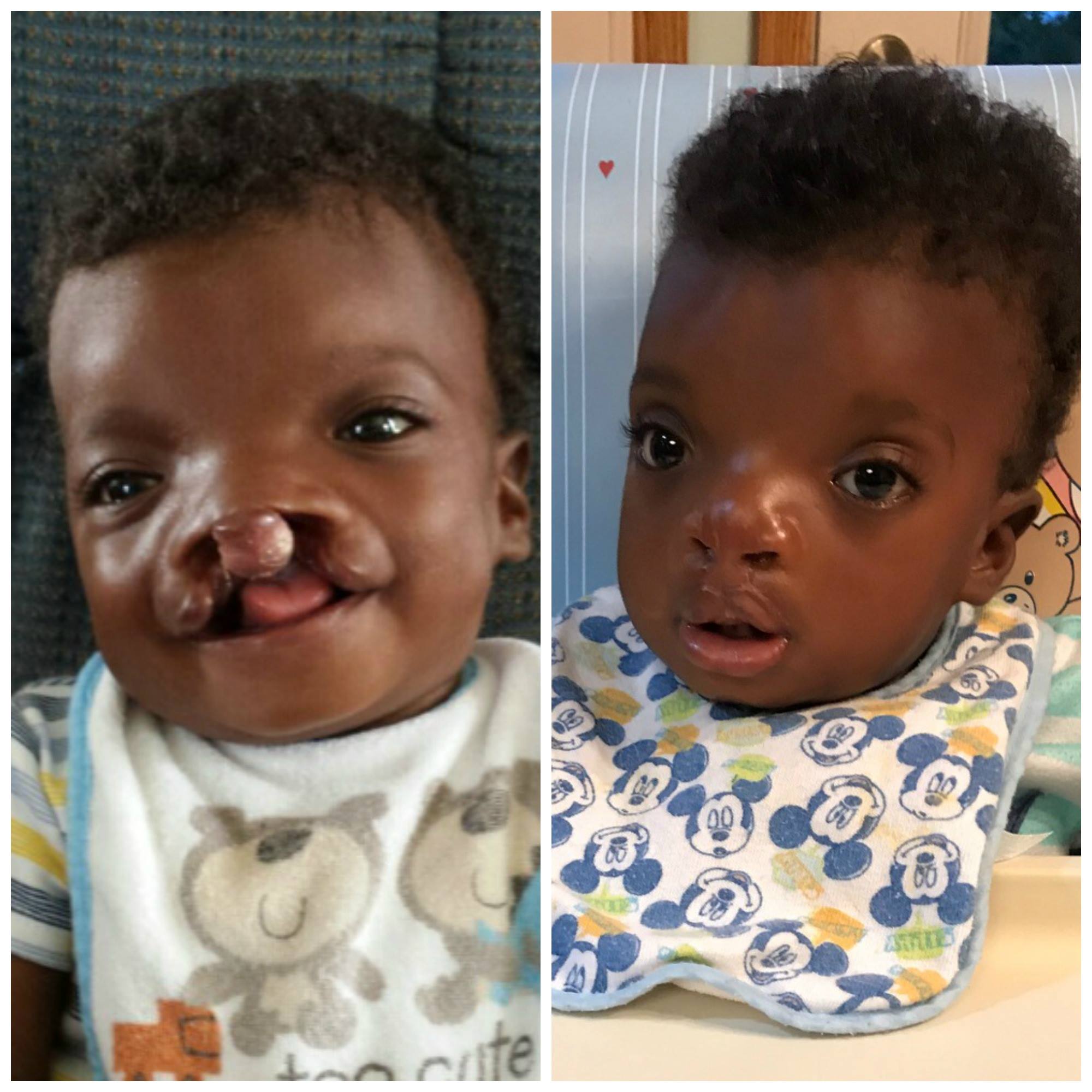 A before and after picture of the children Ray of Hope serves.